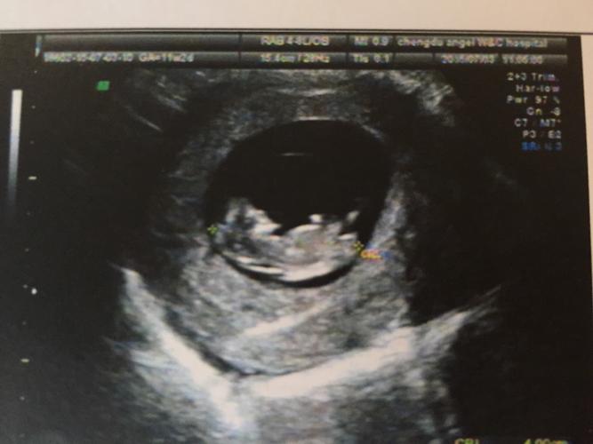 13楼 2015-7-3 孕11周 2小宝宝好可爱[爱心]心率170/分好快的呢