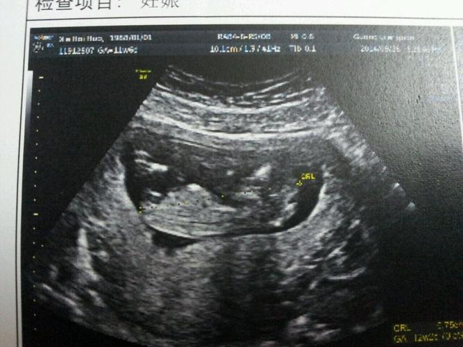 怀孕十二周b超可以看出胎儿是男孩还是女孩吗?