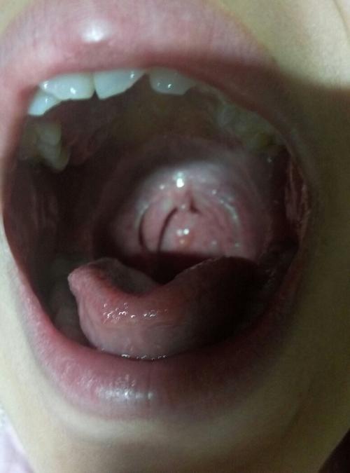 嗓子里长了个疙瘩,不知道是什么?是息肉吗?