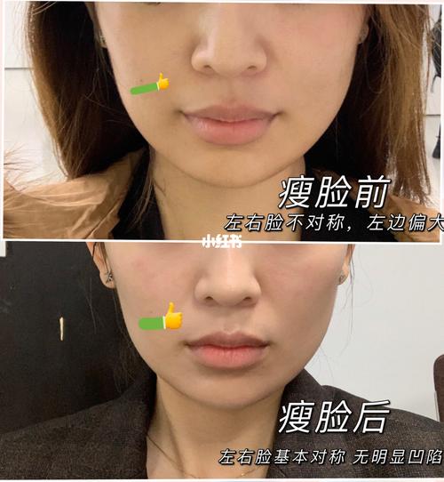 瘦脸针保妥适对比图 南京三甲医院 省人民