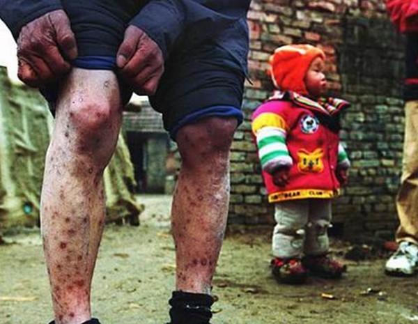 艾滋病人腿部的疱疹,这是艾滋病发病的标志之一.