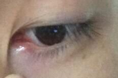 眼睛泪腺旁边肿了,眨眼有点痛