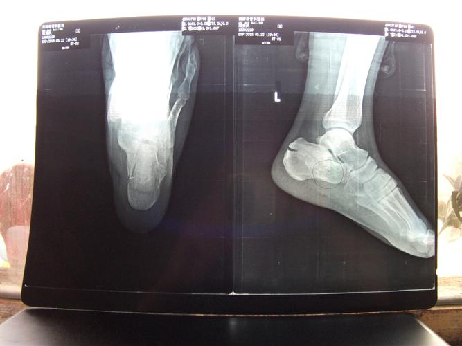 跟骨骨折87天了专家们给看看!