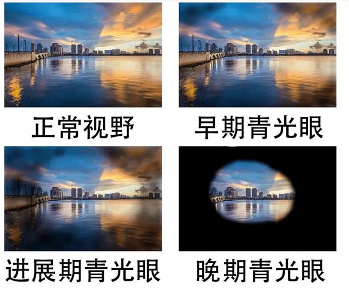 青光眼周丨青光眼是如何剥夺我们的视觉?_视野
