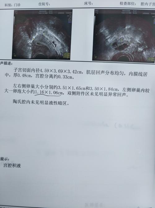 彩超结果显示左侧卵巢内有较大卵泡大小约为116106c