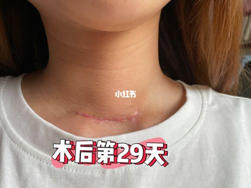 甲状腺手术2个月后伤口恢复情况_甲状腺_祛疤膏_朋友