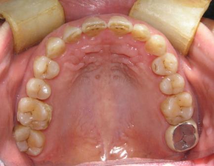 下切牙唇面严重磨耗深覆合矫治案例-3(原创)