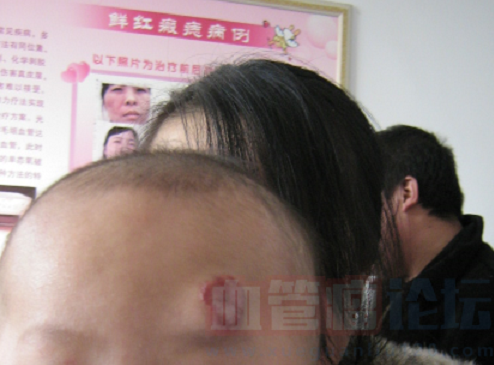 混合型血管瘤的症状会是什么样的