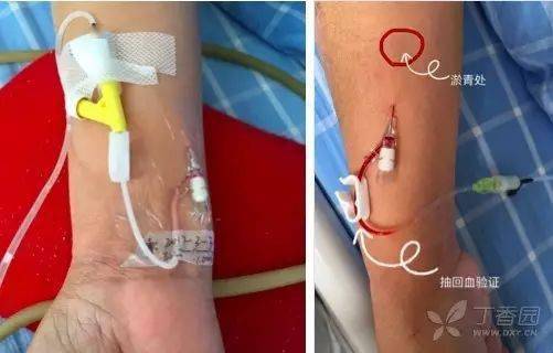 留置针,钢针穿刺:4 招教你加强静脉穿刺技术!