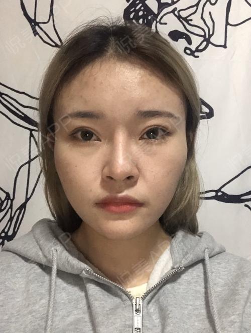 我觉得脸部轮廓不清晰颧骨高给人感觉脸大太凶还有哪里