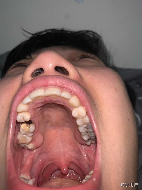 这是我拖了很久的牙照,恶心,不适者