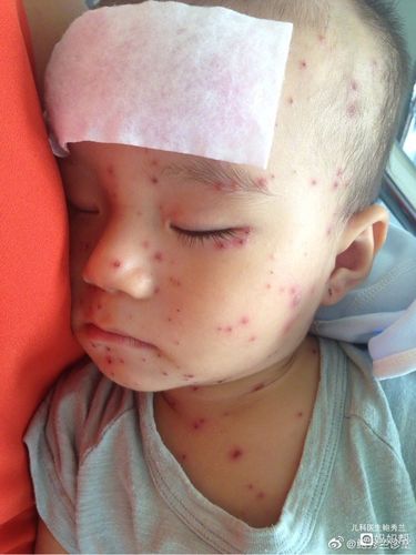 【水痘是由什么引起的,该怎么治疗?】