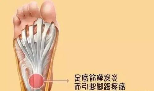 足底脂肪垫萎缩