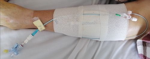 胫前静脉穿刺置入血管鞘及溶栓导管.尿激酶溶栓.