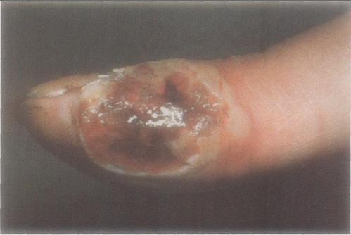 艾滋病人生殖器疱疹      图458  (genital herpes in aids)