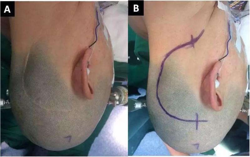 出来,磨钻磨除岩骨,显露岩骨内肿瘤,先切除岩骨内部分肿瘤后,结扎并