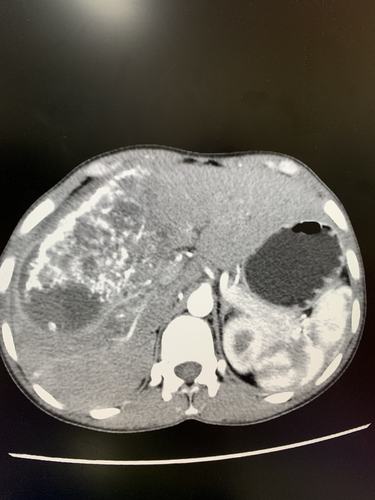 肝s4,s5,s8段切除 胆囊切除 腹腔引流术