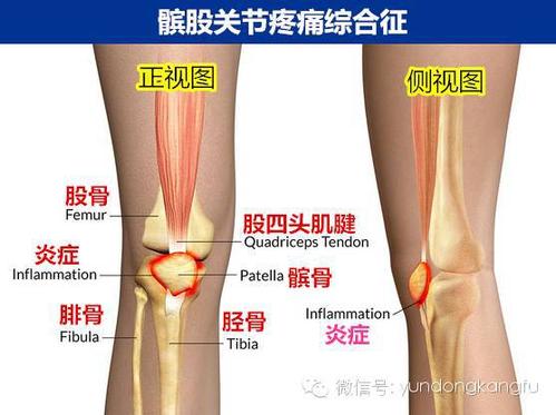 髌骨相关膝关节疼痛问题原因及解决方案