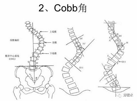 汇总骨科常用角度测量方法全在这里了