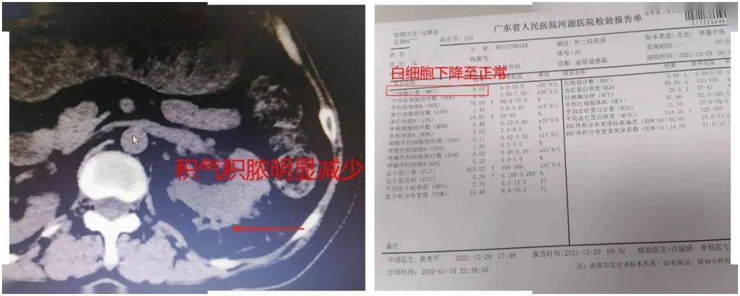 患者治疗后复查ct及血常规检查广东省人民医河源医院泌尿外科在省医