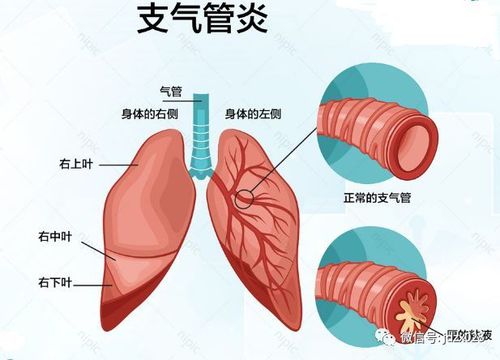 引起支气管炎的病因主要有哪些