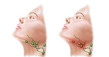 脖子上的淋巴结肿大如何识别是不是肿瘤
