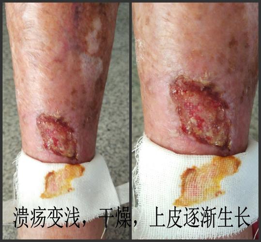 下肢皮肤慢性溃疡