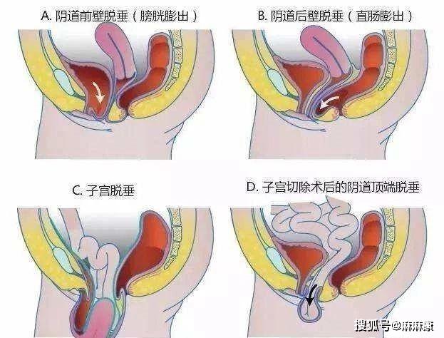 建议子宫脱垂的妈妈减少自己触摸阴道以内器官的行为,这样的操作可能