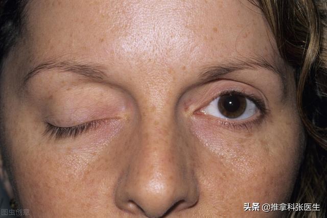 眼睛疼痛,睁不开,伴有头痛,可能是痛性眼肌麻痹