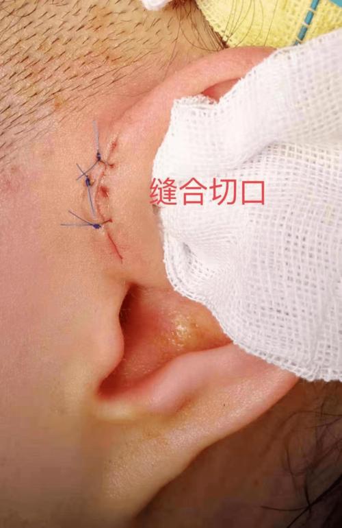 友谊科普全国爱耳日耳仓福兮祸兮