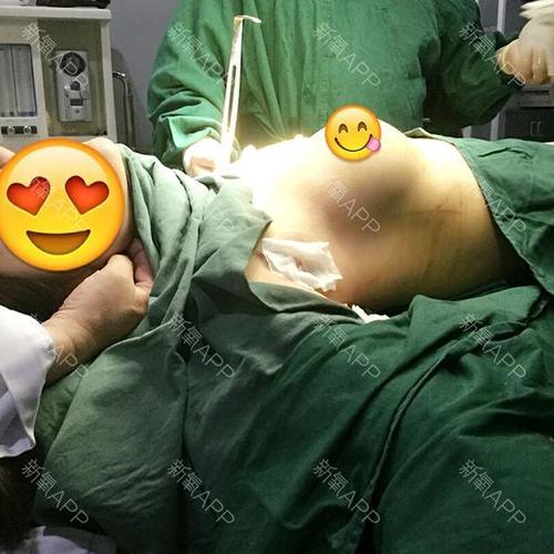氧气_yn2ce9f74假体隆胸第2天美丽日记-新氧美容整形