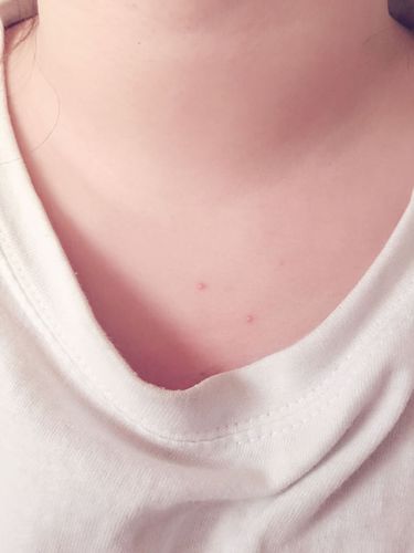 麻烦各位帮忙看一下,从去年开始脖子下面锁骨附近不间断的起这种小脓