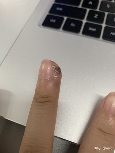 抗战甲周疣正式开始