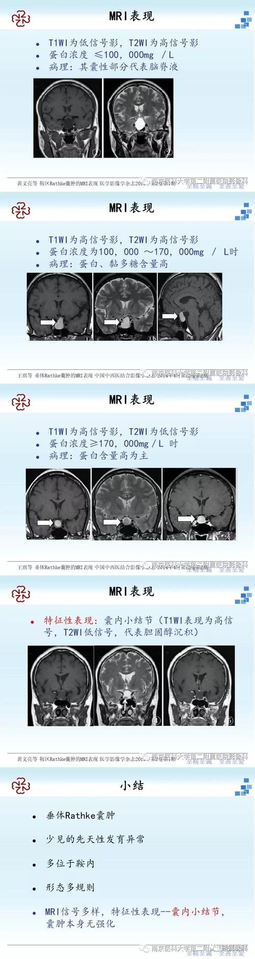 鞍区t1高信号病变之[rathke囊肿]丨小打卡读片精选(27