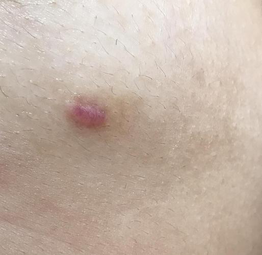 切痣手术一个月后,是疤痕增生吗?更新(有图)