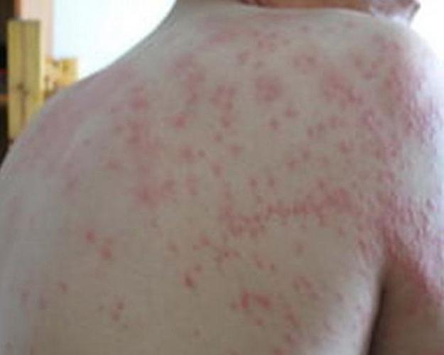 女性背部出现了荨麻疹的图片_有来医生