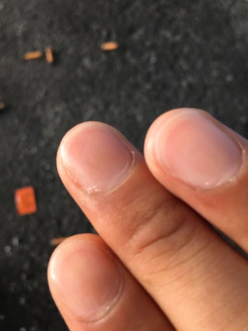 指甲尖发白这是什么引起的