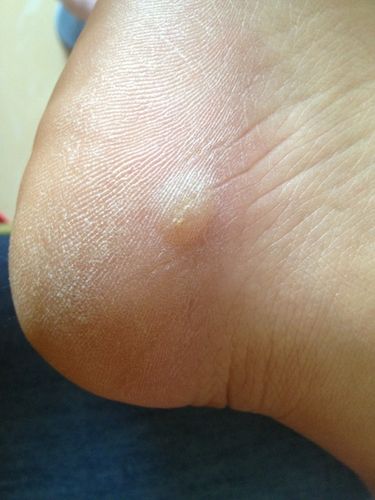 脚上起了一个硬硬的水泡该怎么办(有图片参考)