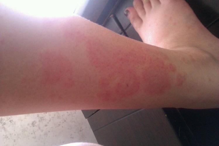 四肢起红斑,痒的厉害,常年有症状,夏天比较严重,冬天不照射阳光也起.