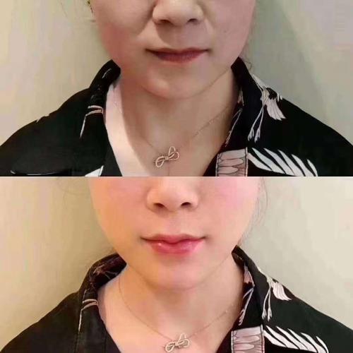 干细胞填充美容院全脸凹陷填充塑形私密紧实饱满胸部丰润自然 5ml