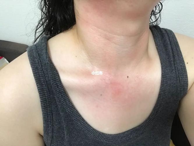 脖子红一整片/又红又痒_皮炎_乳液_日本_防晒_过敏_疫情_晒伤_医疗