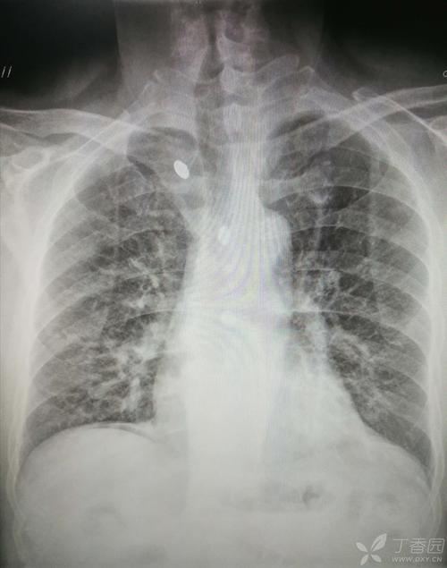 看片诊病之典型急诊胸片分享