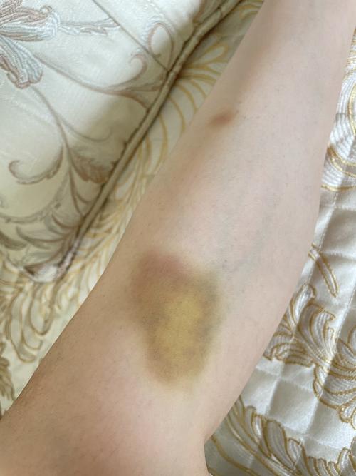 关于莫名其妙的腿部淤青