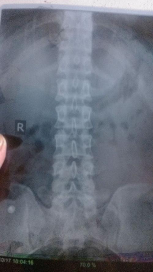 去医院拍片子骨头正常说是腰肌劳损但是今天右边屁股上面又无缘无故疼