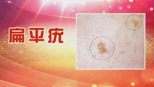 皮肤高危型 疣状表皮发育不良,为米粒或黄豆大小的扁平疣状丘疹,呈淡