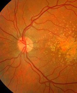 黄斑病可由遗传性病变,老年性改变