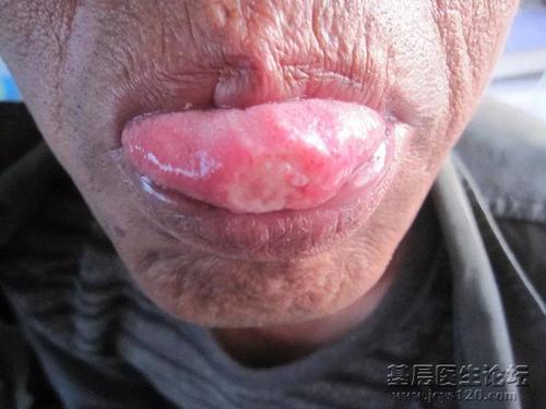 患者男,51岁,因舌尖溃疡3月余未愈再次就诊.