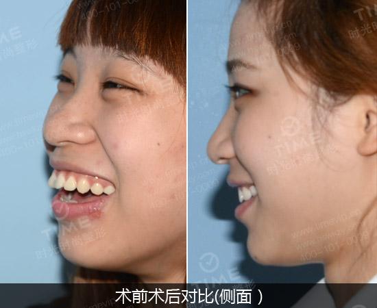 牙齿矫正前后