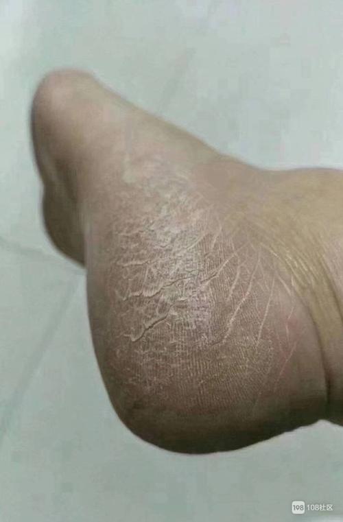 这样的脚后跟医学上叫鳞屑角化型脚气