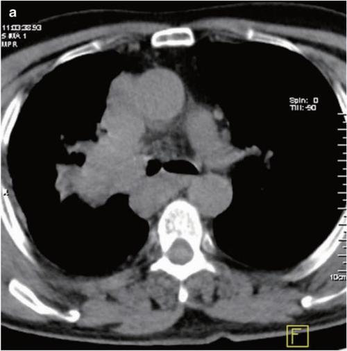 这名患者中,肺癌引起了什么并发症?丨看图识癌